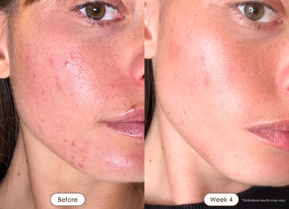 visible results after 4 weeks of using the LED light therapy mask