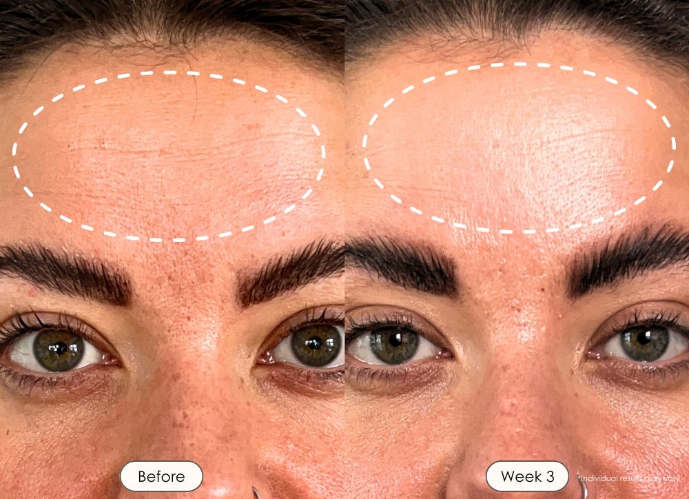 visible results after 3 weeks of using the LED light therapy mask