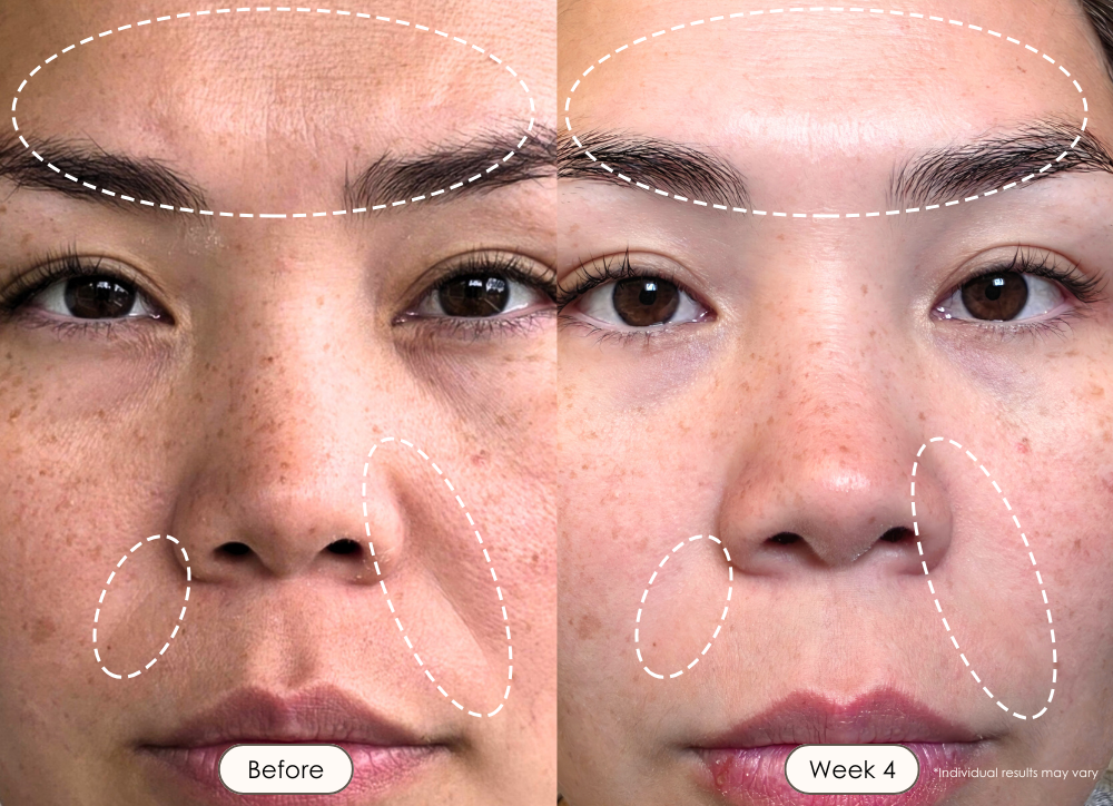 visible results after 4 weeks of using the LED light therapy mask