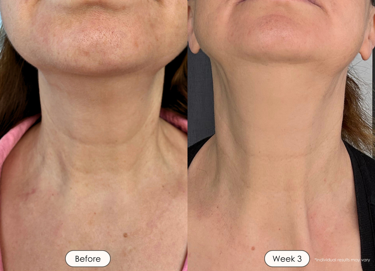 visible results after 3 weeks of using the LED light therapy neck and face mask