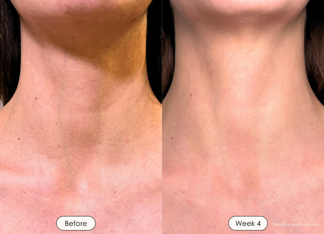 Before and after red light therapy showing improved neck skin tone
