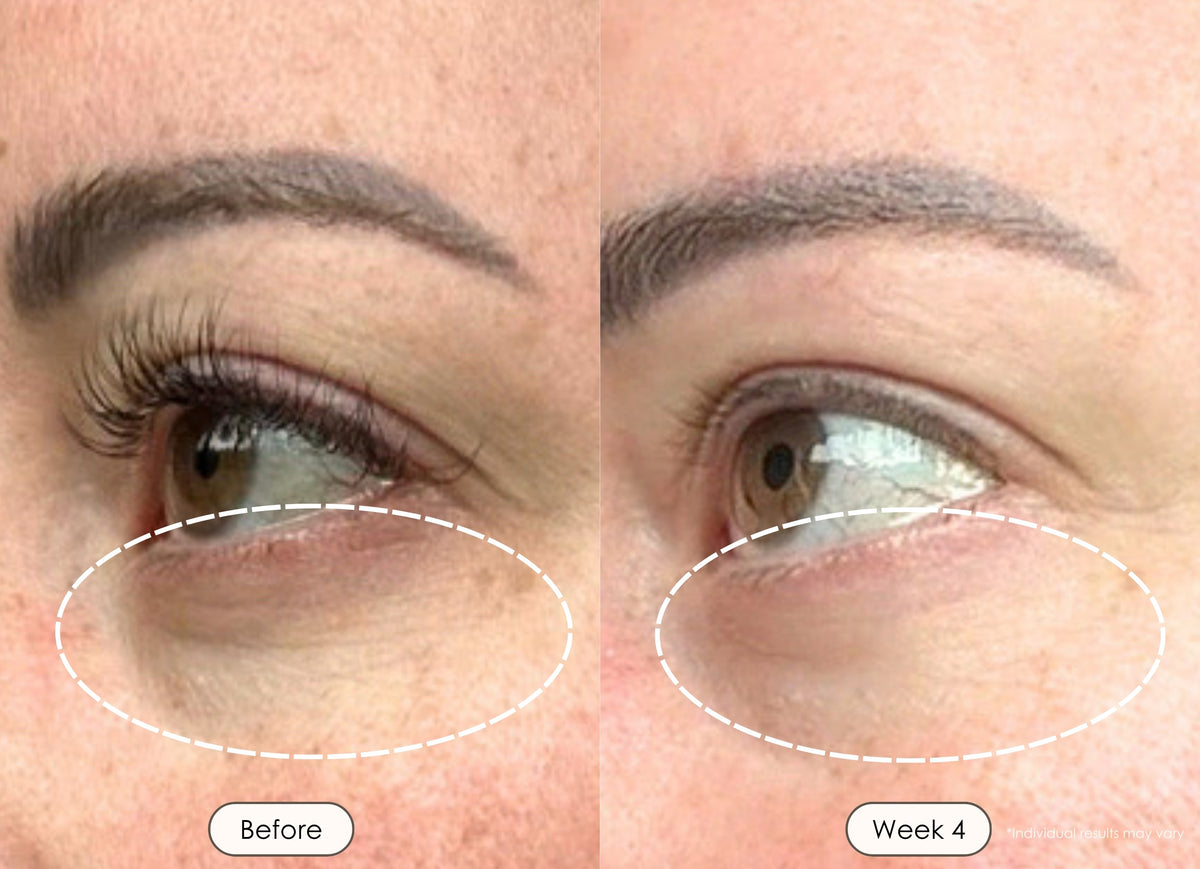Before and after under-eye results, Week 4 treatment of a woman.